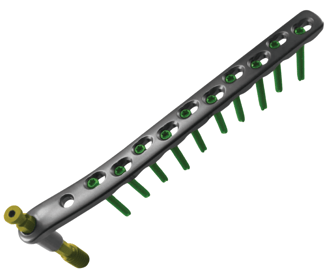 Placa para Fémur Distal Condylar DCS 95°