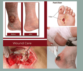 Wound Care