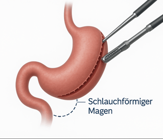 a diagram of a stomach cancerous stomach cancer