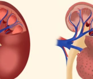 Best Chronic Kidney Disease treatment in Madinaguda