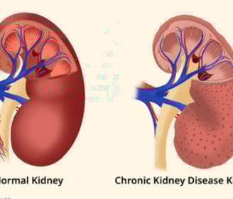 chronic kidney disease