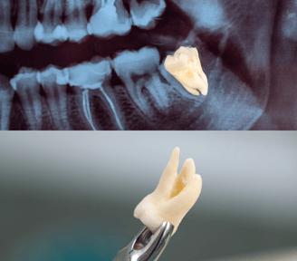 wisdom tooth extraction in Navi Mumbai | Ekdantam Dental Clinic kopar khairane