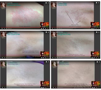 skin after electrolysis treatment