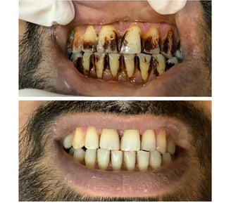Teeth Cleaning
