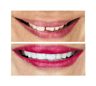 dental veneers