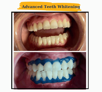 Teeth Whitening
