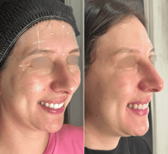 Botox-preenchimento-labial-bio-estimulador-de-colageno-em-pitanga-região-dra.-josiane