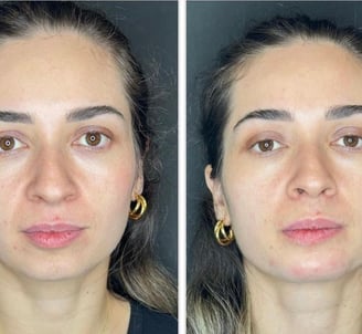 Botox-preenchimento-labial-bio-estimulador-de-colageno-em-pitanga-região-dra.-josiane