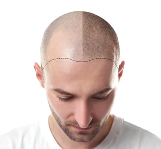 hair transplant-saç ekim