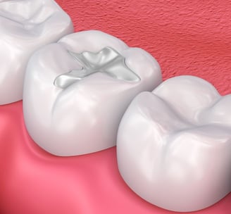 dental fillings ultra smile london