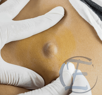 xérese de Cistos Sebáceos, Lipomas e Nevus Clinica ELITE