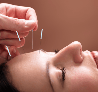 acupuntura facial. dor de cabeça. relaxamento. tratamentos naturais. saúde natural.