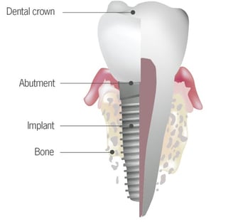 Best Dental Implants treatment in Wadgaon sheri pune