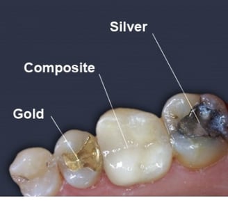 Best Dentist for Tooth Coloured Filling In Pune