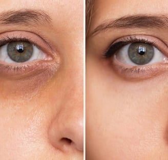 Botox-preenchimento-labial-bio-estimulador-de-colageno-em-pitanga-região-dra.-josiane