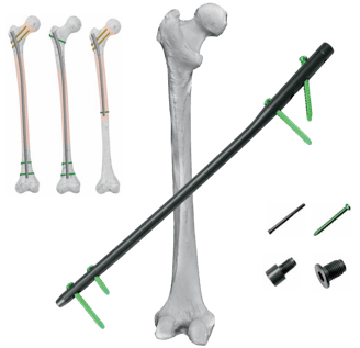 Clavo Intramedular para Fémur