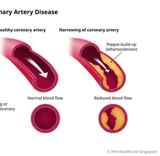 coronary artery disease
