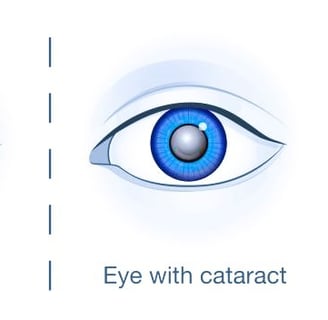 cataracts