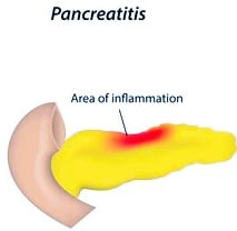 pancreatitis