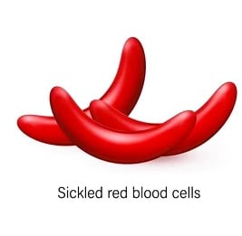 Sickle Cell