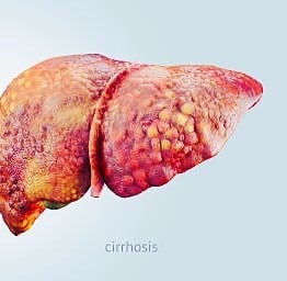 lever cirrhosis