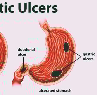 peptic ulcers