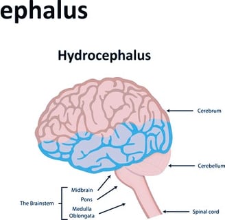 Hydrocephalus