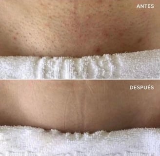 Antes y después de tratamiento láser para foliculitis en zona íntima femenina
