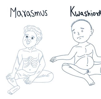 Marasmus