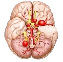 cerebral aneurysm