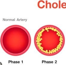 cholesterol