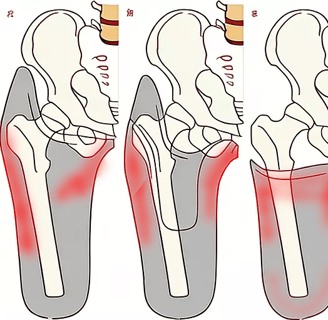 contact pressures and sensitive areas on trans femoral amputation