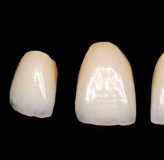 corona dental ceramica
