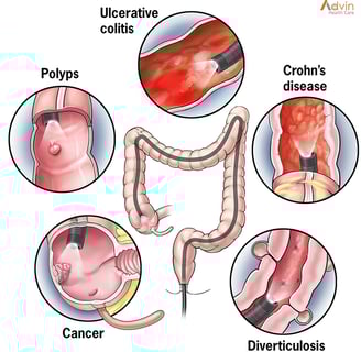 a colon with reasons of why colonoscopy is done