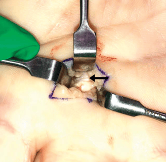 Incisión de 1cm realizada para tratar el dedo en gatillo, la flecha muestra la polea A!
