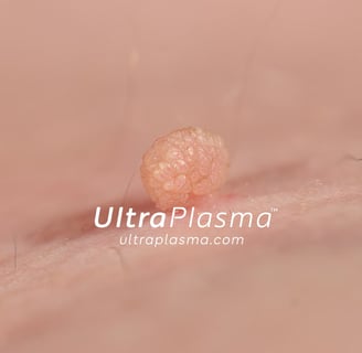 ultraplasma.com_skin_tag_removal_treatment_et_beni_temizleme_silme_tedavi_ultra_plasma_ultra_plazma2