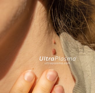 ultraplasma.com_skin_tag_removal_treatment_et_beni_temizleme_silme_tedavi_ultra_plasma_ultra_plazma