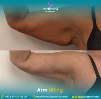 Arm lift before and after