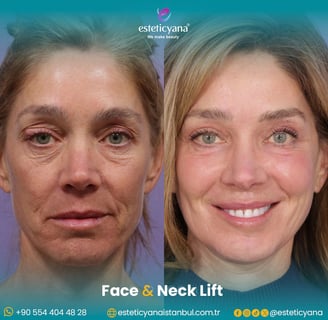 Face and neck lift before and after