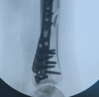 Placa para Tibia Distal