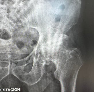 artrosis de cadera