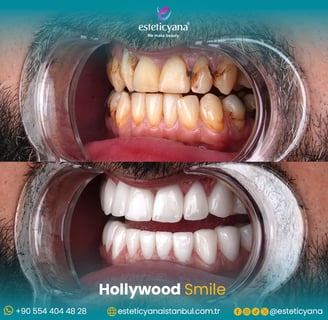 Hollywood smile before and after