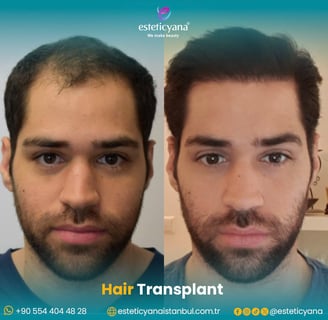 hair transplant before and after