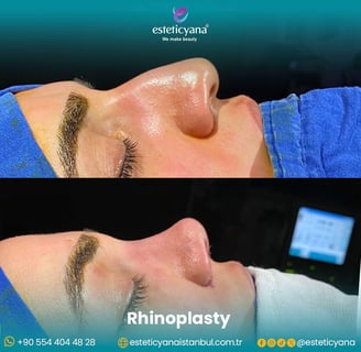 Rhinoplasty before and after
