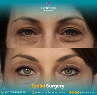 blepharoplasty before and after