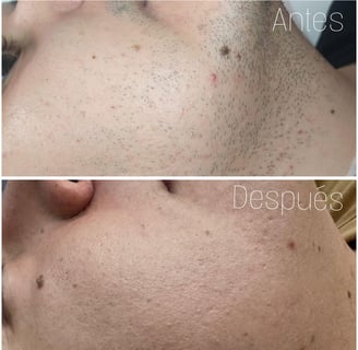 Mejora en cicatrices de acné y textura facial con láser en Tu Piel Láser Center Bogotá
