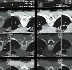 ct scan dataset