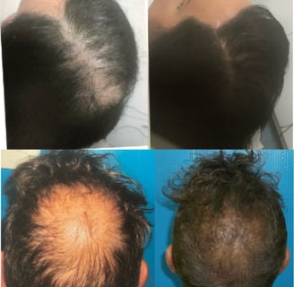 Result of taking TruVarin for Hair growth