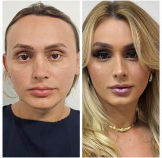 feminização facial frontoplastia