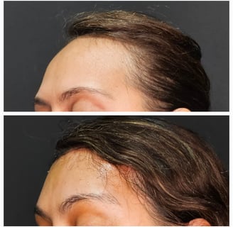 feminização facial frontoplastia